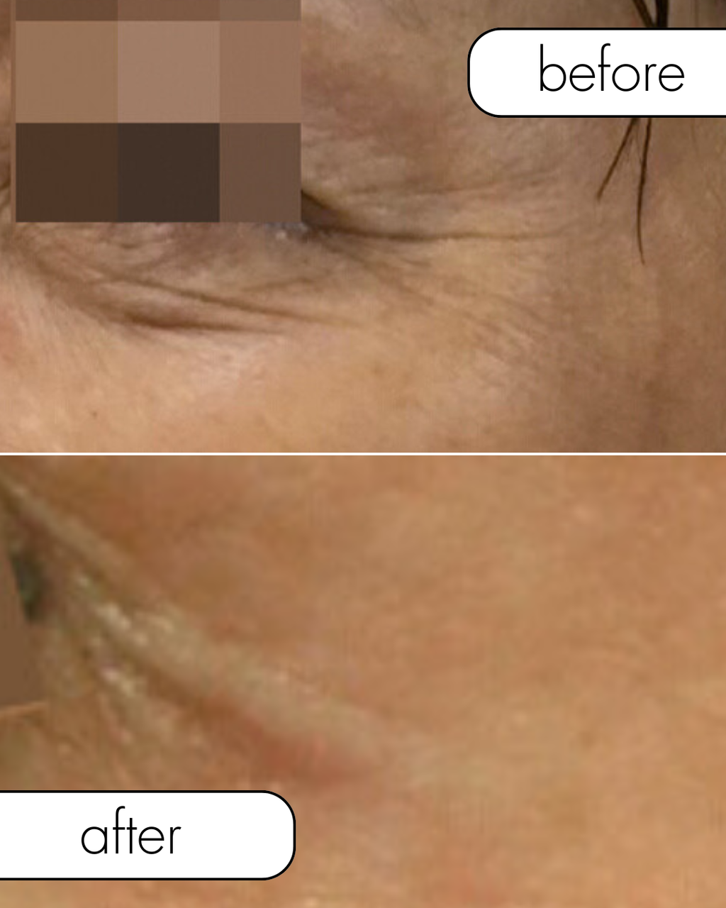Mesoestetic® Mesoéclat® Pack