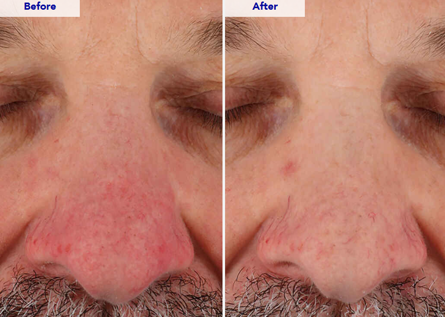 A screenshot of a ZO Skin Health webpage showing before-and-after close-up photos of a person's red, irritated nose area, alongside clinical results text.