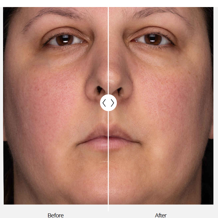  ZO Skin Health showing a before-and-after facial skin comparison on a person's face, with large text stating 92% of subjects reported healthier skin by week 4.