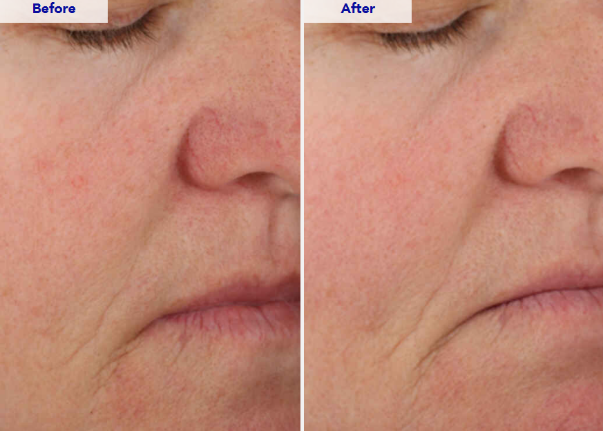 A screenshot of a ZO Skin Health webpage showing before-and-after close-up photos of a person's cheek and mouth area, alongside text claiming clinically shown results.