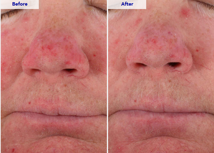 A screenshot of a ZO Skin Health webpage showing before-and-after skin results on a person's face, with text claiming 100% hydration and visible redness reduction.